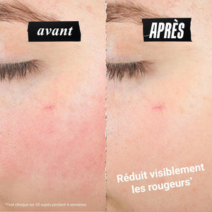 Kiehl's Ultra Facial Meltdown Recovery Cream 50ml - redness before and after